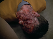 Gallery Image Subnucleonic radiation poisoning